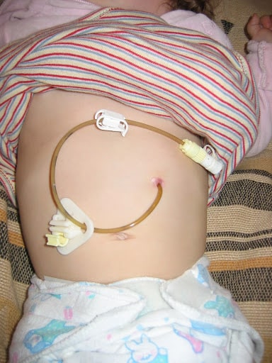 Feeding Tubes